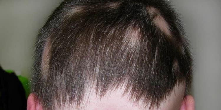 Стригущий лишай у детей на голове: фото, признаки и лечение в домашних условиях