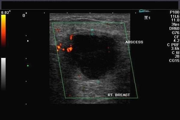 Ультразвук при лактостазе, физиотерапия: можно ли делать УЗИ при грудном вскармливании?