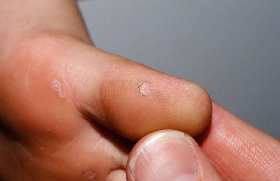 Как избавиться от подошвенной бородавки на стопе у ребенка: способы лечения и удаления