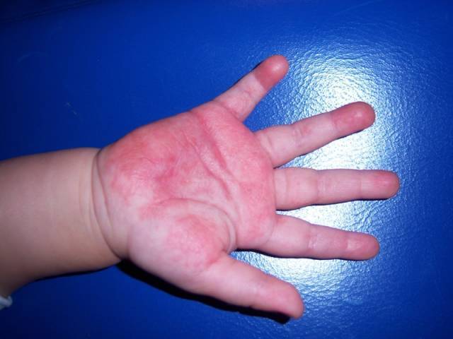 Псевдотуберкулез у детей: симптомы и лечение начальной и последующих стадий