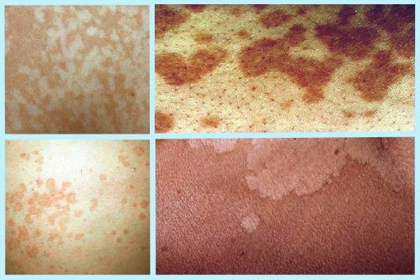 Розовый лишай у ребенка: фото, признаки и лечение в домашних условиях