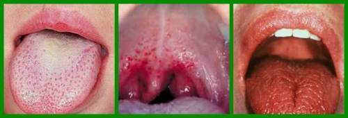 Красные точки во рту у ребенка - сыпь на слизистой неба и горла: фото с пояснениями