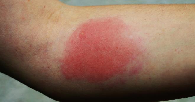 Мазь от укусов насекомых для детей: чем лечить опухоль и покраснение, как снять отек?