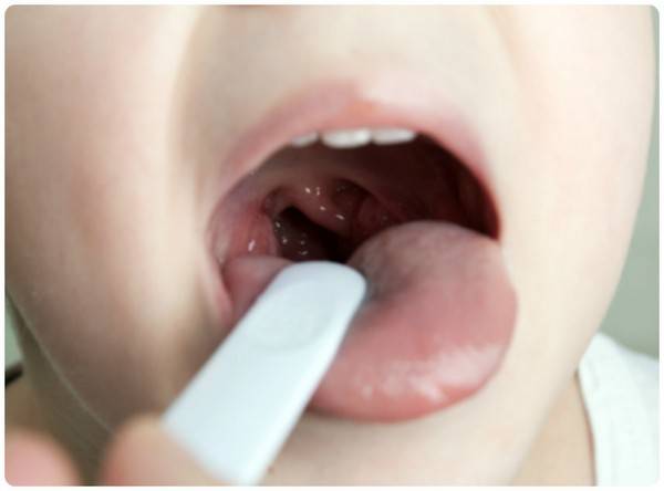 Симптомы грибковой ангины у детей и лечение инфекции противогрибковыми препаратами