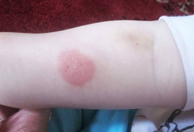 Положительная реакция Манту: что это значит и что делать родителям ребенка?