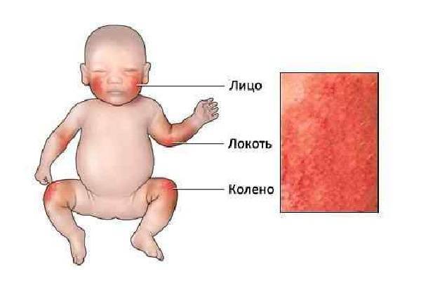 Розовый лишай у ребенка: фото, признаки и лечение в домашних условиях