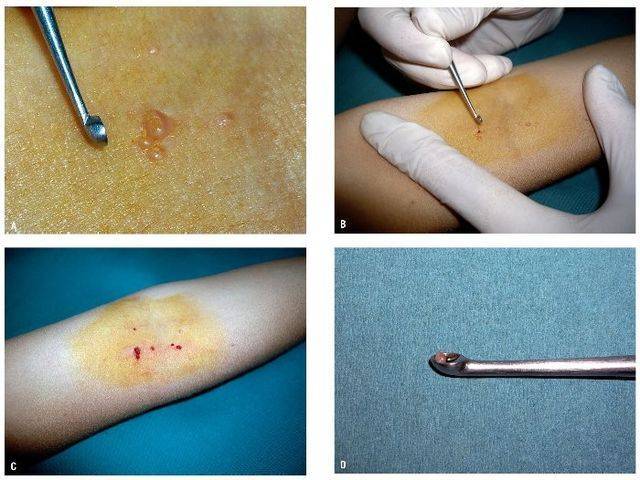 Контагиозный моллюск у детей: фото на коже, лечение и удаление на разных стадиях болезни