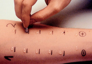 Анализ на аллергены у ребенка: сдача крови, кожные пробы, провокационный тест при аллергии