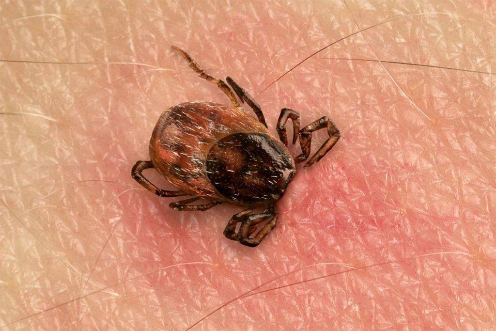 Энцефалит: симптомы у детей при вирусной инфекции после укуса клеща, лечение болезни