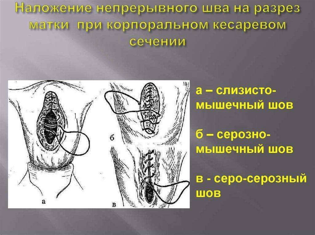 Почему после кесарева сечения на шве может появиться уплотнение, что делать?