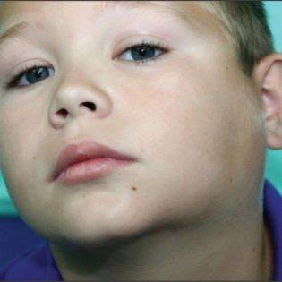 У ребенка опухла шея с одной стороны под ухом: причины, сопутствующие симптомы и лечение