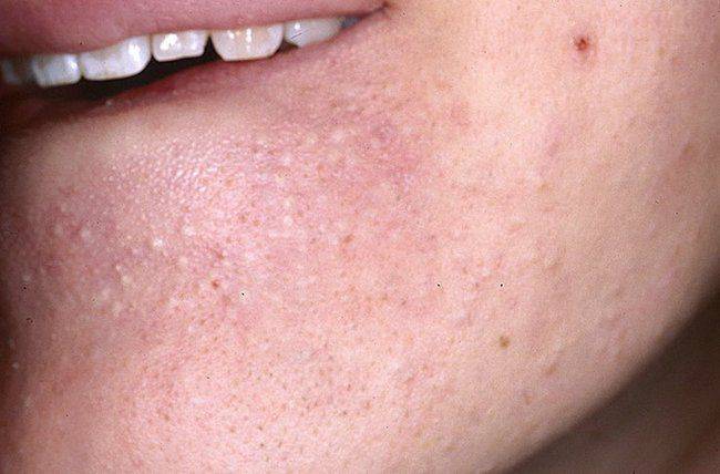 Что делать при аллергии на подбородке у детей. причины появления сыпи у ребенка на подбородке: раздражение от слюней, аллергия и другие проблемы покраснение на бороде у ребенка