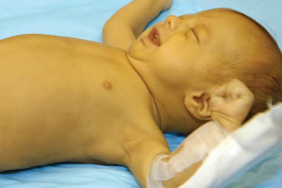 Желтуха у новорожденных: причины, последствия и лечение (физиологическая, неонатальная, ядерная)