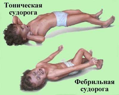 Судороги у ребенка при температуре: что делать - первая помощь при фебрильных судорогах