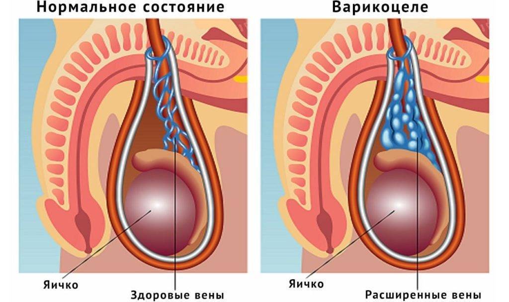 Водянка яичка у ребенка: фото у новорожденных мальчиков, причины гидроцеле, последствия
