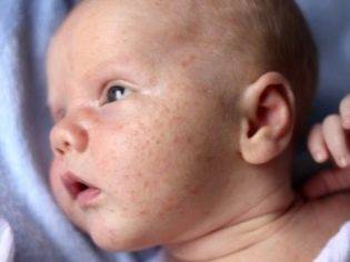 Сыпь у ребенка на попе - фото прыщей с пояснениями, причины аллергии и сухой кожи, лечение