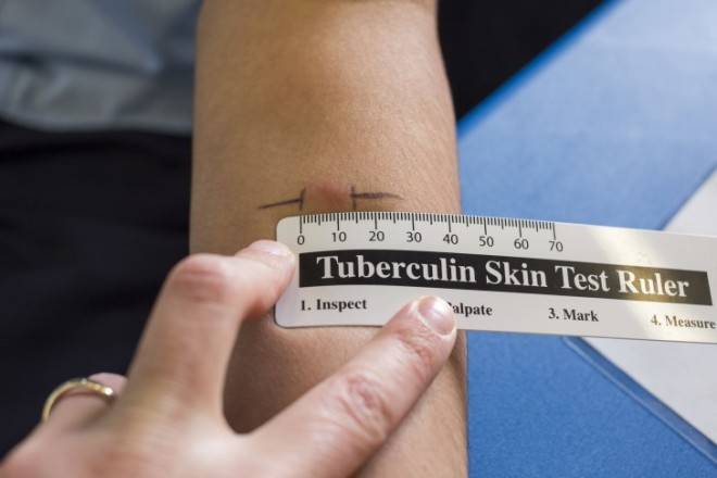 Реакция Манту у детей: норма размеров по возрасту в 1-3 года с фото