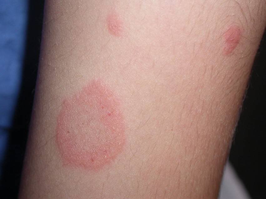 Чем лечить лишай у ребенка в домашних условиях, как вывести, чтобы быстро прошел: народные средства