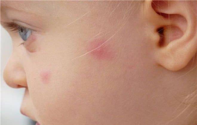 Анализ крови на туберкулез вместо Манту и другие альтернативы проверки реакции для ребенка