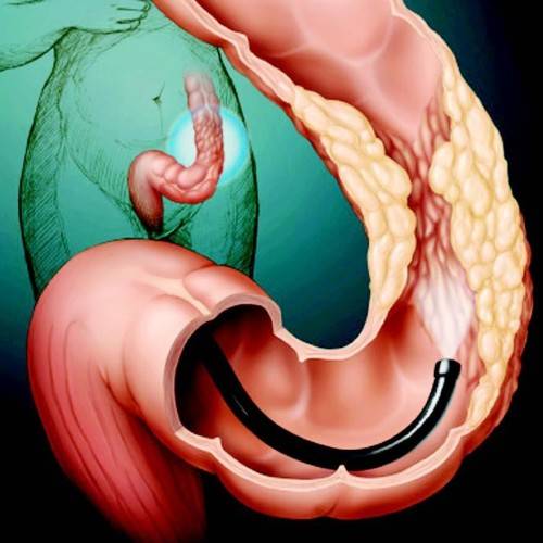 Тонкий эндометрий и беременность: вероятность зачатия и вынашивания ребенка, норма толщины в цикле