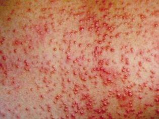 Сыпь в паху у ребенка - раздражение в интимной зоне, покраснение и зуд на половых органах