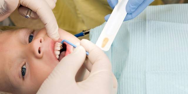 Серебрение зубов у детей - фото до и после, фторирование как альтернатива