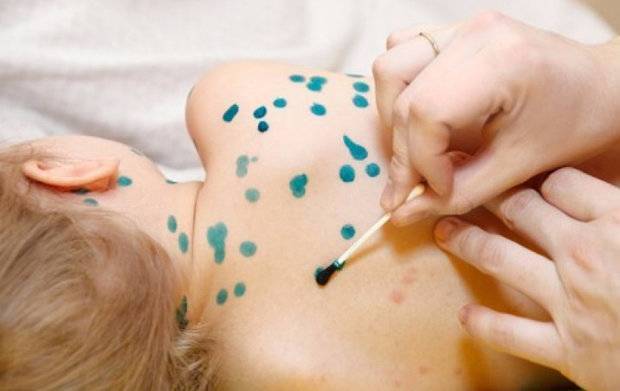 Чем лечить ветрянку у детей в домашних условиях: быстро и пошагово