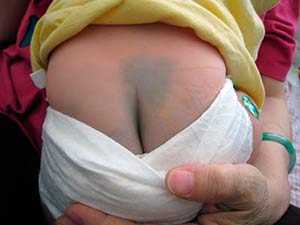 Монгольское пятно у новорожденных (монголоидное): фото, причины, значение