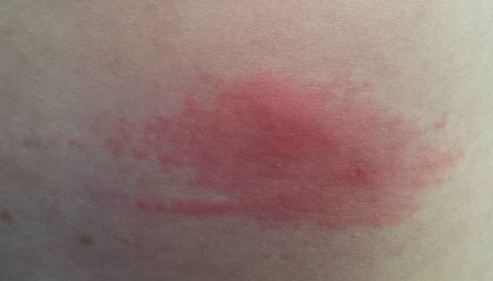 Шершавые пятна на теле у ребенка (на коже ног и рук, на спине и лице): фото