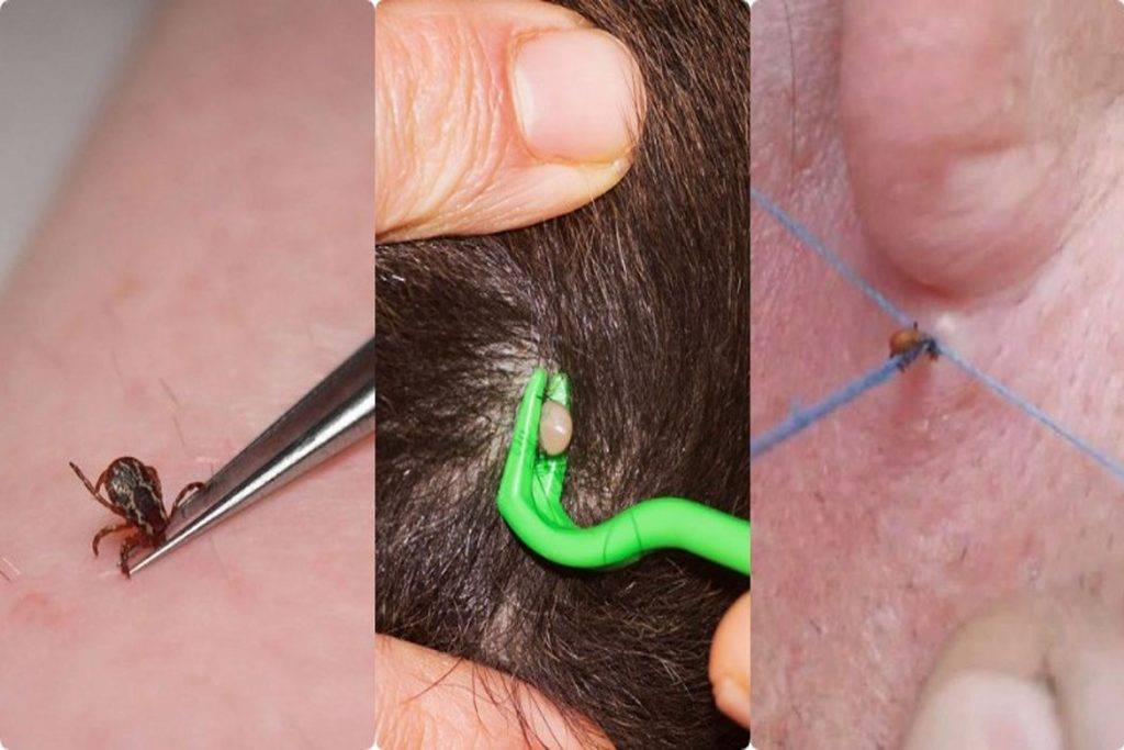 Ребенка укусил клещ: что делать, через какое время видны симптомы - фото и признаки укуса