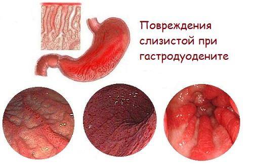 Гастродуоденит у детей: симптомы и лечение, диета при заболевании