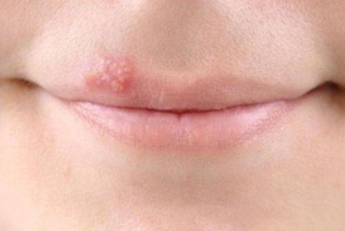 Герпес у детей: виды вируса, симптомы заболеваний, лечение и профилактика