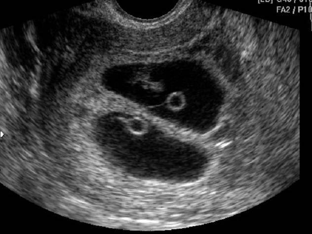 Желточный мешок: норма по неделям беременности, размеры на ранних и поздних сроках