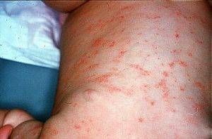 Симптомы перорального дерматита у детей на лице и эффективные способы лечения