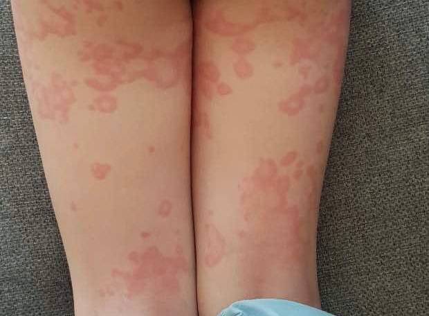 Шершавые пятна на теле у ребенка (на коже ног и рук, на спине и лице): фото