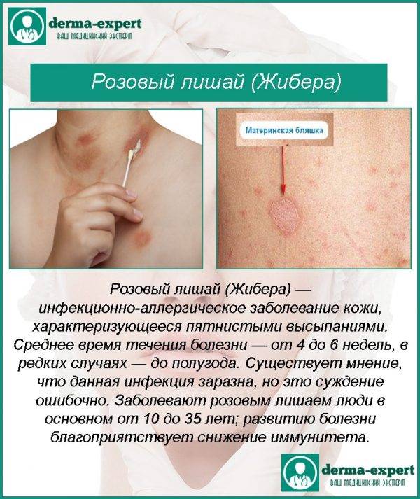 Розовый лишай у ребенка: фото, признаки и лечение в домашних условиях