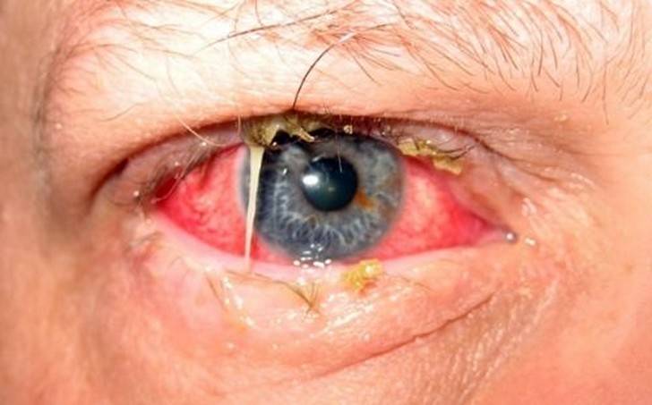 Лечение конъюнктивита при беременности в 1, 2 и 3 триместрах, последствия для плода