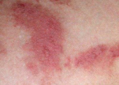 У ребенка на языке пятна: красные, как ожог (фото, диагноз, лечение и причины)