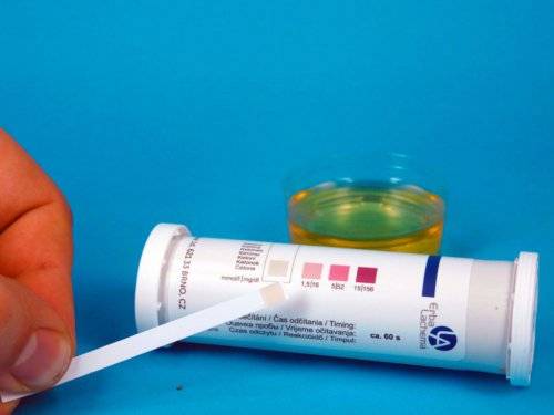 Что означает повышение глюкозы в моче у ребенка: причины и способы коррекции