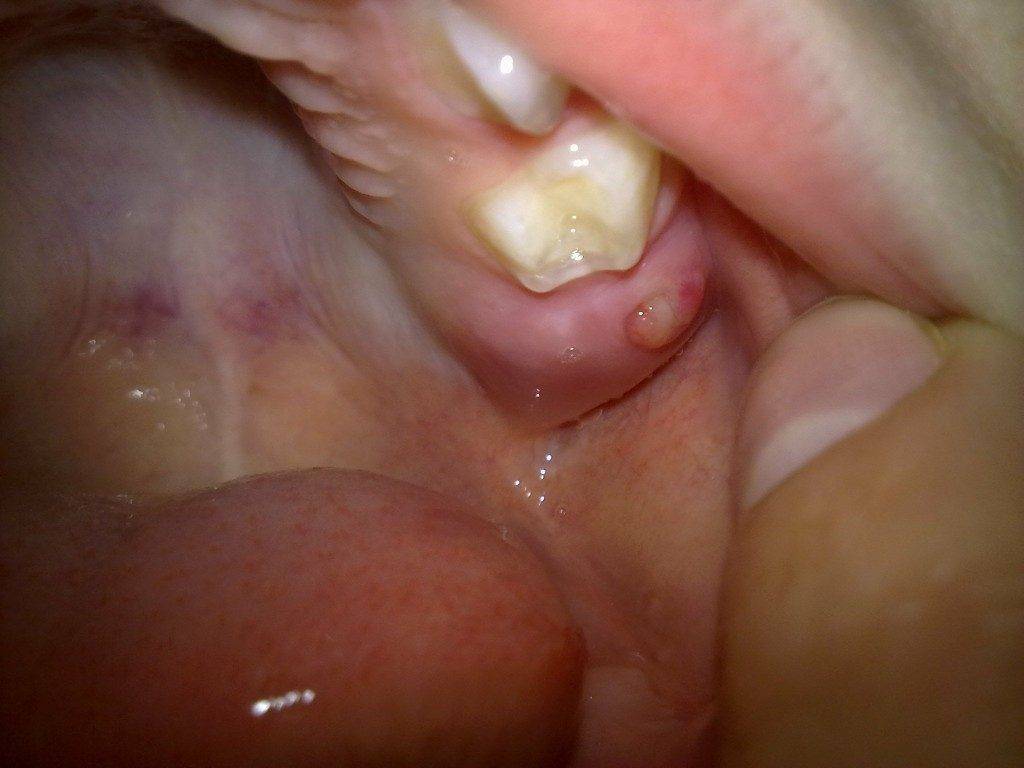 Нарост на десне у ребенка - фото эпулиса, симптомы при прорезывании зубов, лечение