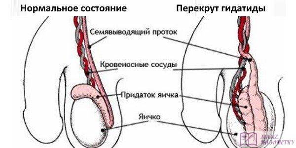 Перекрут гидатиды яичка у детей: симптомы, причины появления у мальчиков, последствия после операции