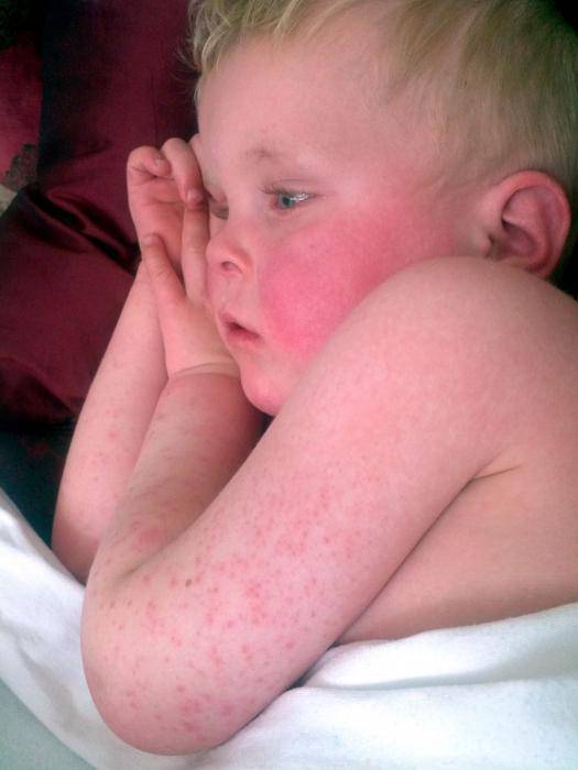 Псевдотуберкулез у детей: симптомы и лечение начальной и последующих стадий