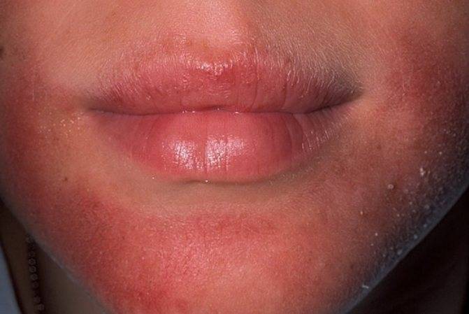 Симптомы перорального дерматита у детей на лице и эффективные способы лечения