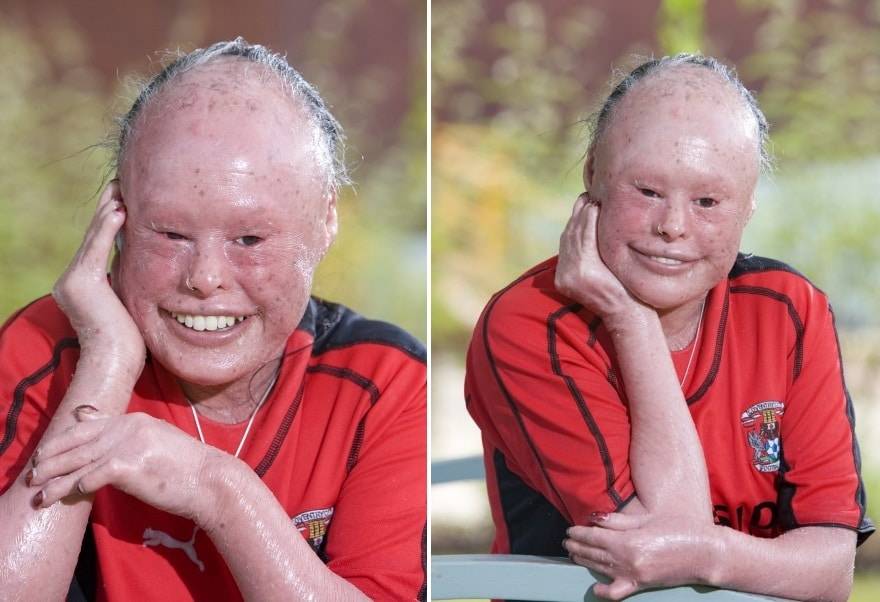 Ихтиоз кожи у детей: опасно ли это заболевание для новорожденных, что делать и как лечить?