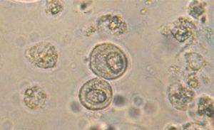 Эпителий плоский в моче при беременности: норма, причины отклонения