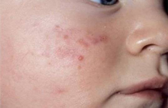 Везикулопустулез у детей - фото патологии у новорожденных, симптомы, причины, лечение