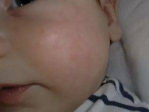 Аллергия на витамин Д у грудничков: фото, симптомы, может ли быть негативная реакция у детей?