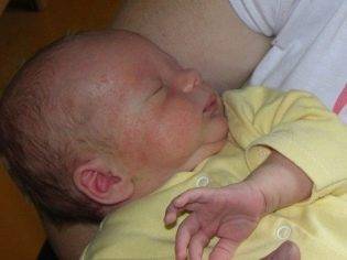 Сыпь у ребенка на попе - фото прыщей с пояснениями, причины аллергии и сухой кожи, лечение