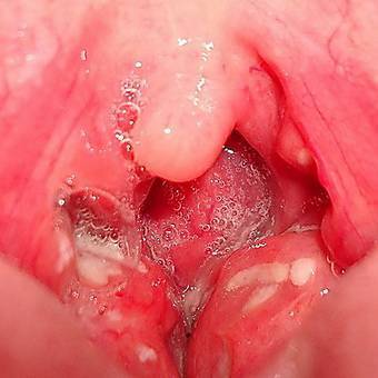 Лакунарная ангина у детей - лечение и симптомы заболевания с фото