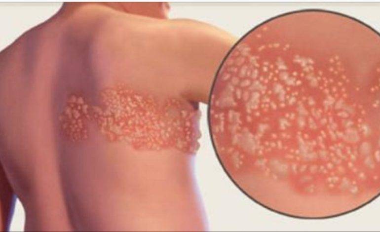 Опоясывающий лишай у детей - симптомы и лечение вируса герпес Зостер